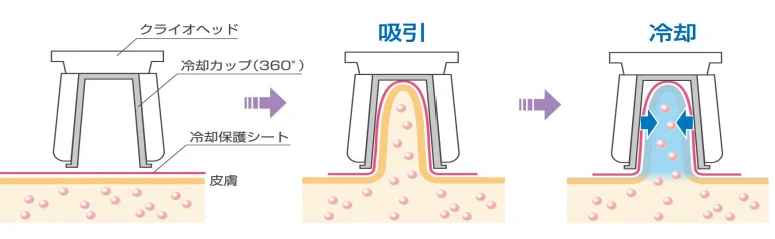 脂肪冷却　吸引カップ Cryolipolysis 脂肪冷却吸引機 クライオ